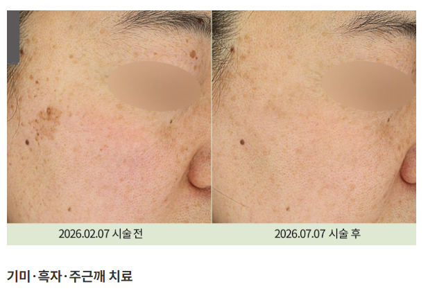 기미·잡티·흑자 관련 치료 사진