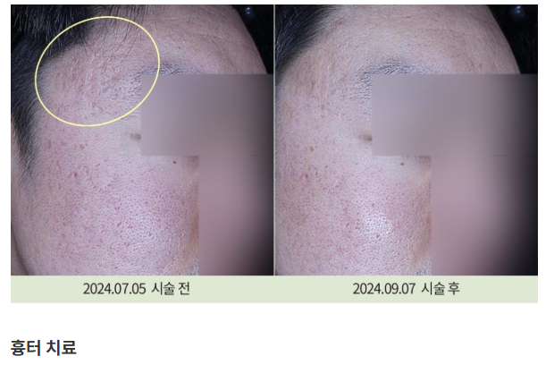 여드름흉터치료 관련 장비 또는 제품 사진